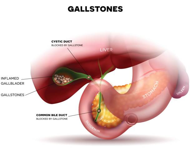 Stones in the Gallbladder Stones in the Gallbladder and anatomy of other surrounding organs gall bladder stock illustrations