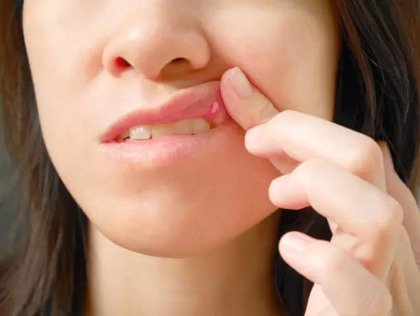 Photo of Canker sore on woman upper lip