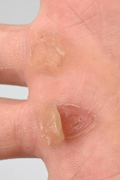 istock detail of calluses on the palm, 660410000