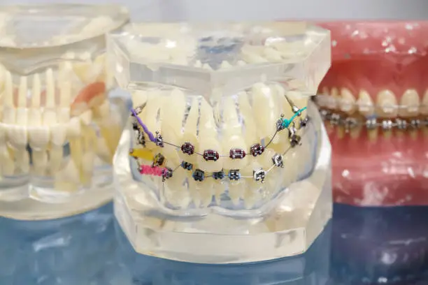 Human jaw or teeth orthodontic dental model with implants, dental braces