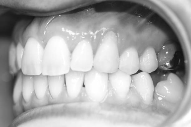 istock View of an adults teeth and gums 660719364