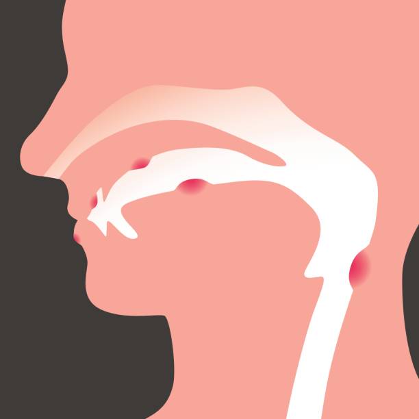 oral disease, image illustration oral disease, image illustration human mouth stock illustrations