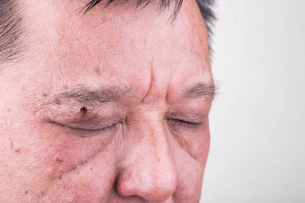 Mole removed from neck and shoulder via skin graft procedure leaving scar on Asian man