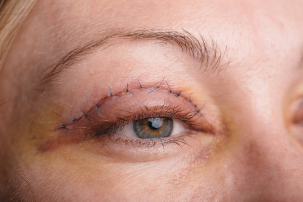 Blepharoplasty of the upper eyelid. Blepharoplasty of the upper eyelid. An operation that removes the excess ugly skin of the eyelids above the eyes. The photos show seams. This is the third day after the operation. defection stock pictures, royalty-free photos & images