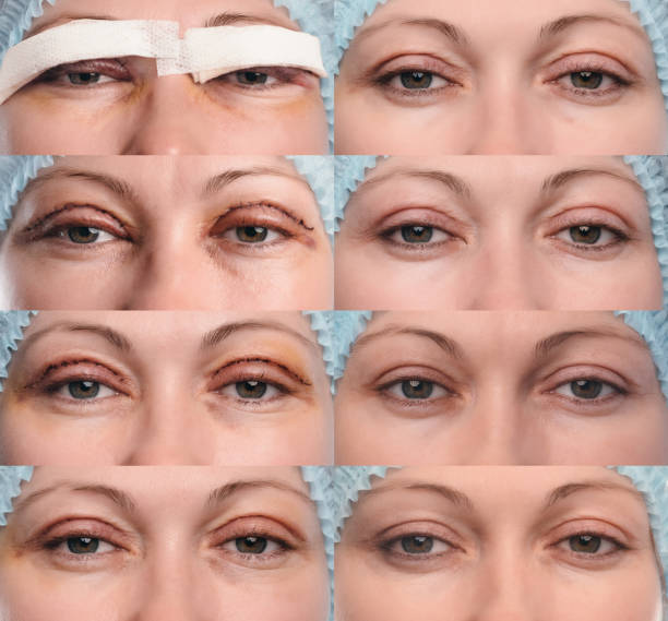 istock Blepharoplasty of the upper eyelid. 664480874
