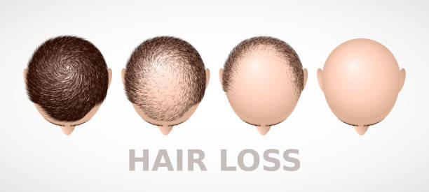 haarausfall. satz von vier stufen der alopezie - glatzenbildung stock-grafiken, -clipart, -cartoons und -symbole