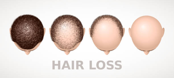 ilustraciones, imágenes clip art, dibujos animados e iconos de stock de pérdida de cabello. conjunto de cuatro etapas de la alopecia - completely bald