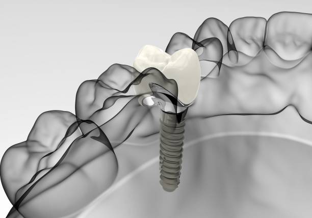 illustrazioni stock, clip art, cartoni animati e icone di tendenza di impianto di rendering 3d - impianto dentale