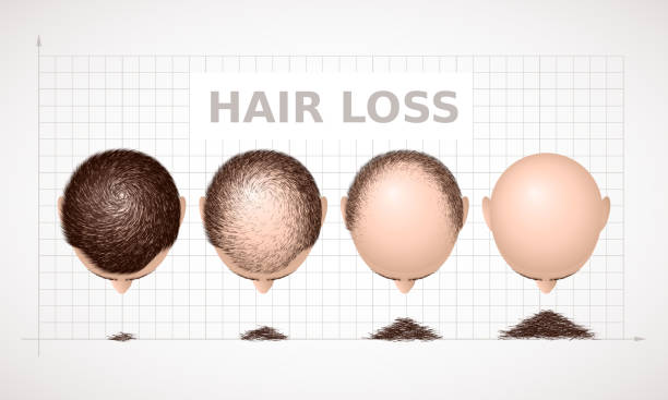 ilustrações, clipart, desenhos animados e ícones de perda de cabelo. gráfico de quatro estágios de alopecia - alopecia homem