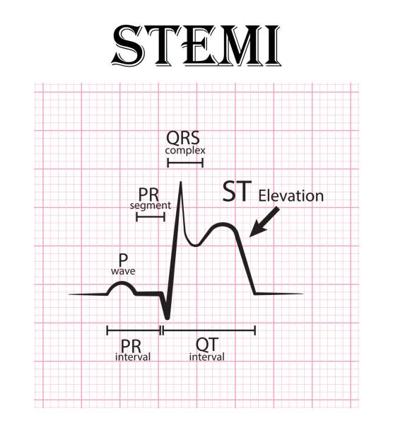 心電図の st 上昇型心筋梗塞 (stemi) と心電図の詳細 (p 波、pr セグメント、pr 間隔、qrs、qt 延長、st に昇格、t 波) 急性冠症候群、狭心症 - pulse trace taking pulse computer monitor healthcare and medicine点のイラスト素材／クリップアート素材／マンガ素材／アイコン素材