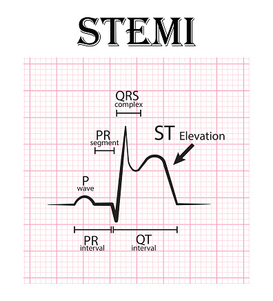 ECG of ST elevation myocardial infarction ( STEMI ) and detail of ECG ( P wave , PR segment , PR interval , QRS complex , QT interval , ST elevate , T wave )  Acute coronary syndrome , angina pectoris