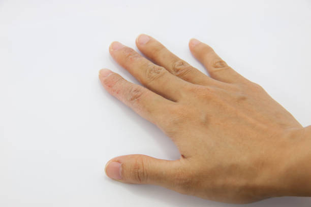 istock Eczema Dermatitis on Back of Hand and Fingers 667021570