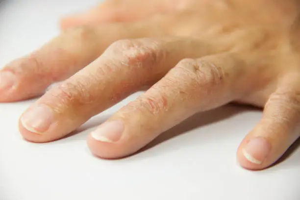 Eczema Dermatitis on Back of Hand and Fingers.