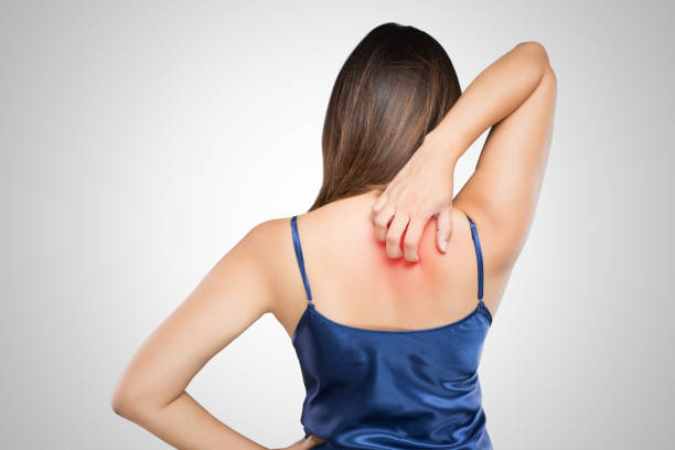 Woman scratching her itchy back with allergy rash, Concept with Healthcare And Medicine. Woman scratching her itchy back with allergy rash, Concept with Healthcare And Medicine. ringworm photos stock pictures, royalty-free photos & images