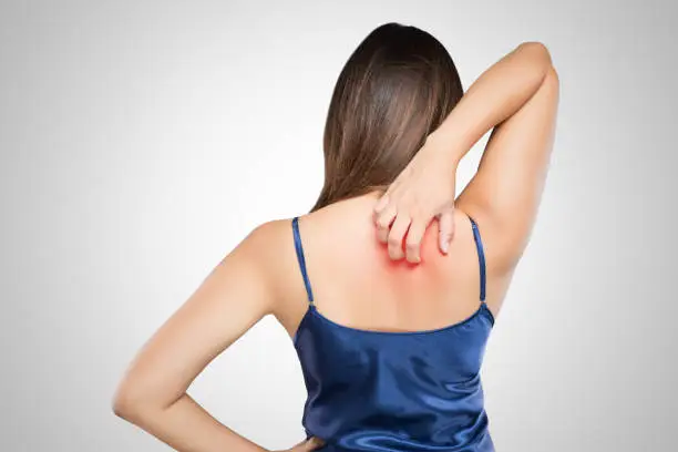 Woman scratching her itchy back with allergy rash, Concept with Healthcare And Medicine.