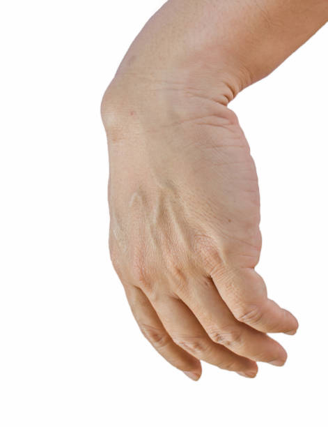 istock Ganglion cysts 667361054