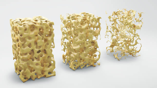 knochen-struktur 3d illustration, normal und mit osteoporose - osteoporose stock-grafiken, -clipart, -cartoons und -symbole