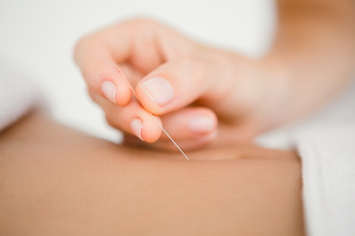 Mujer que sostiene una aguja en una terapia de acupuntura photo