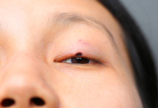 istock The wound medicine at eyelid. 667698142