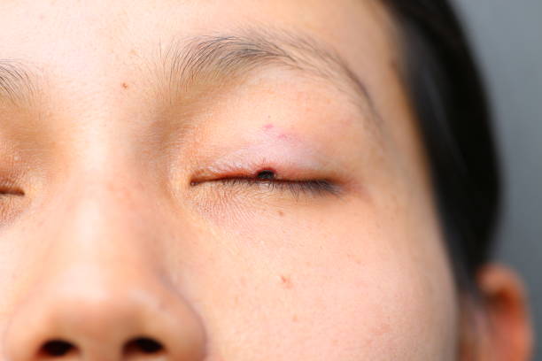istock The wound medicine at eyelid. 667698352