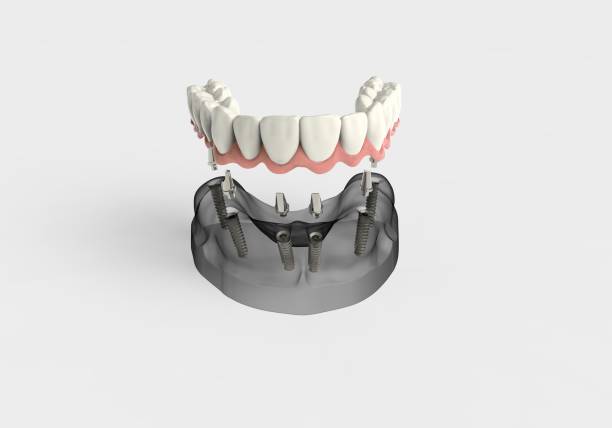 3d-rendering implantat - menschlicher-zahn stock-grafiken, -clipart, -cartoons und -symbole