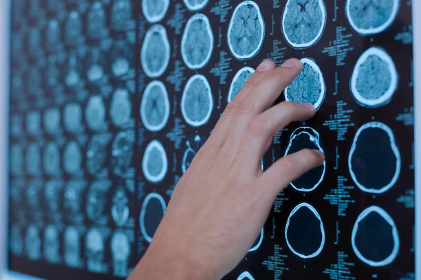 istock Doctors hand pointing at the brain photo 667835522