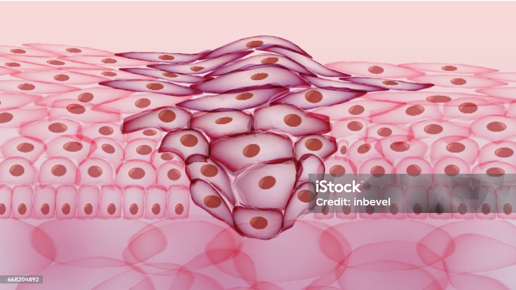 Tumor en crecimiento, sección de tejido - ilustración vectorial - arte vectorial de Célula cancerígena de animal libre de derechos