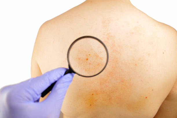 istock Checking psoriasis on the back of a man 668613632