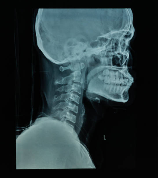 istock X Ray file of human skull in black background 668620524