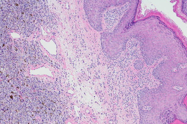 istock Micrograph of vulvar malignant melanoma. 669374154