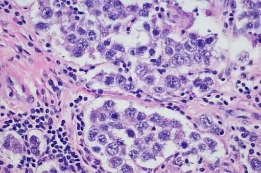 A dysgerminoma is a tumor of the ovary that is composed of primitive, undifferentiated germ cells. Germ cell tumors arise from primordial germ cells of the ovary ; however, pathogenesis of the ovarian germ cell tumors is unknown.