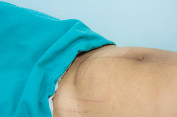 istock Scar on Cesarean Section wound. abdominal 669519822