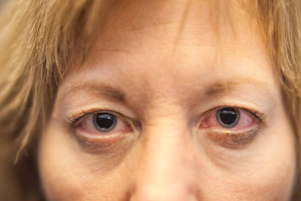 Dilated pupils Close up of red dry eyes with dilated pupils of a Caucasian woman after an opthamologist eye exam appointment gray eyes photos stock pictures, royalty-free photos & images