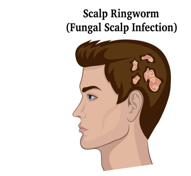Illustration of Scalp Ringworm A young man with symptoms of a fungal infection of the scalp (ringworm) tinea stock illustrations