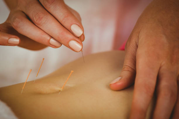 istock Young woman getting acupuncture treatment 670239964