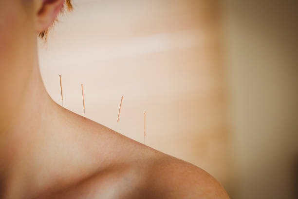 istock Young woman getting acupuncture treatment 670240312