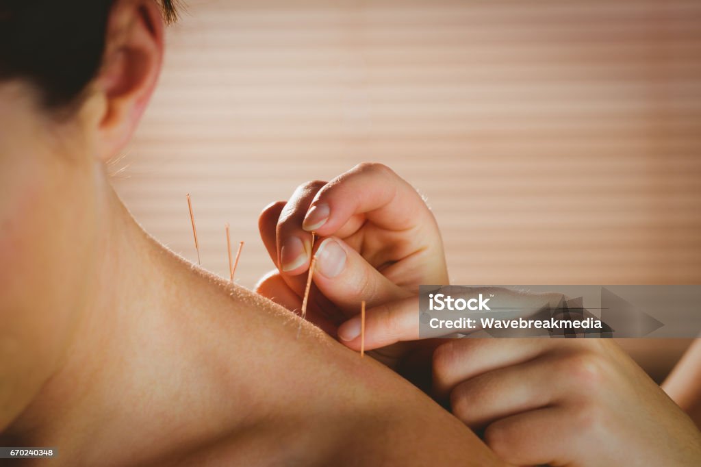 Young woman getting acupuncture treatment Young woman getting acupuncture treatment in therapy room Acupuncture Stock Photo
