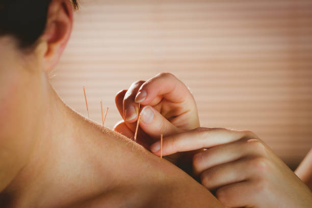 Young woman getting acupuncture treatment Young woman getting acupuncture treatment in therapy room neck photos stock pictures, royalty-free photos & images