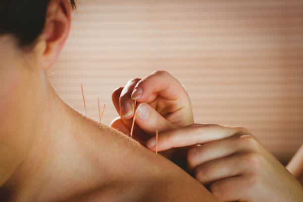 Young woman getting acupuncture treatment Young woman getting acupuncture treatment in therapy room acupuncture stock pictures, royalty-free photos & images