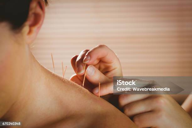 Young Woman Getting Acupuncture Treatment Stock Photo - Download Image Now - Acupuncture, Beauty Treatment, Healthcare And Medicine