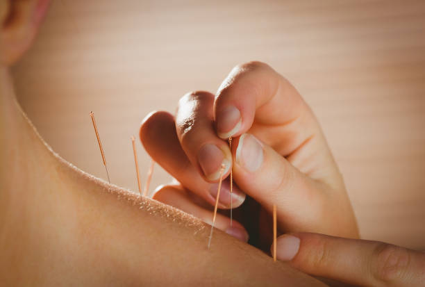 istock Young woman getting acupuncture treatment 670240380