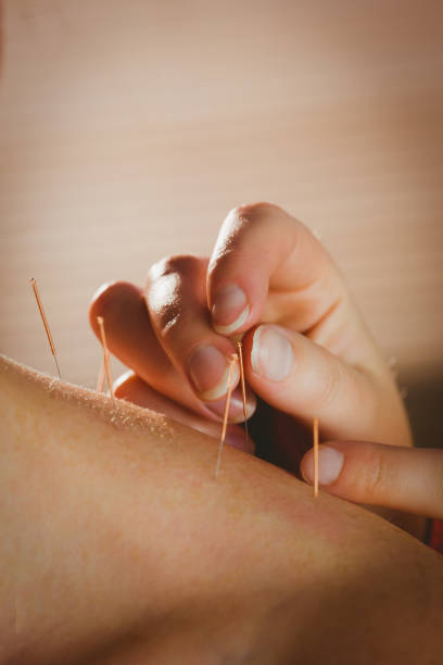 istock Young woman getting acupuncture treatment 670240420