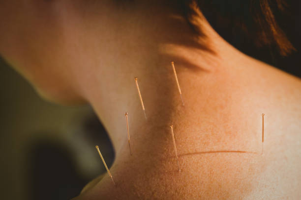 istock Young woman getting acupuncture treatment 670240484