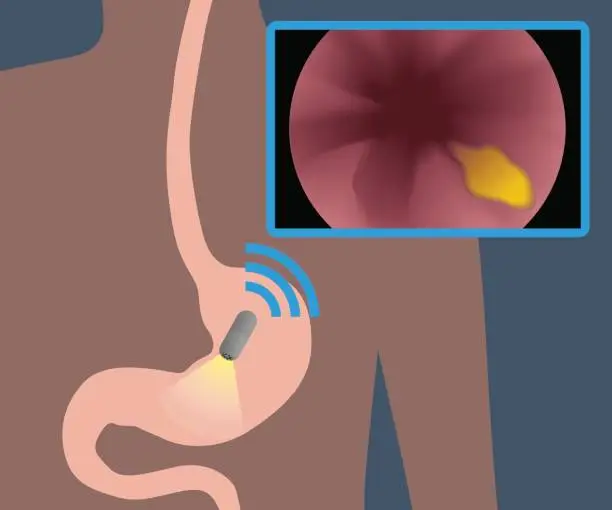 Vector illustration of Capsule endoscopy and wireless communication, vector illustration