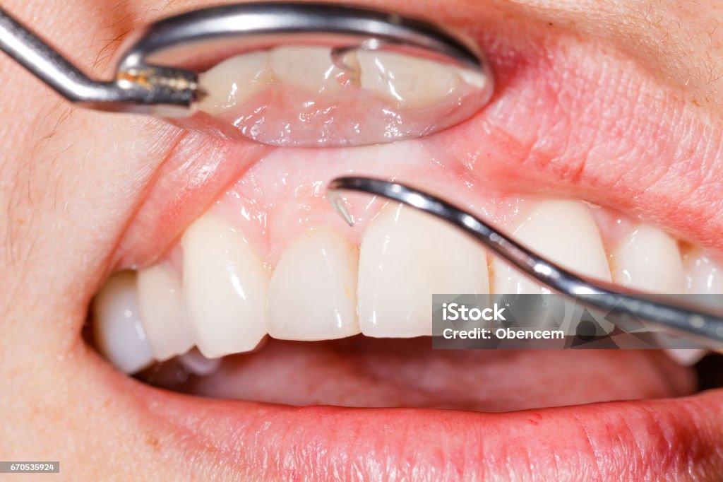 Dental examination Periodic dental examination to have a healthy mouth and teeth. Angled Mirror Stock Photo