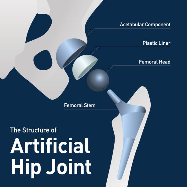 인공 고관절, 벡터 일러스트 레이 션의 구조 - hip replacement stock illustrations