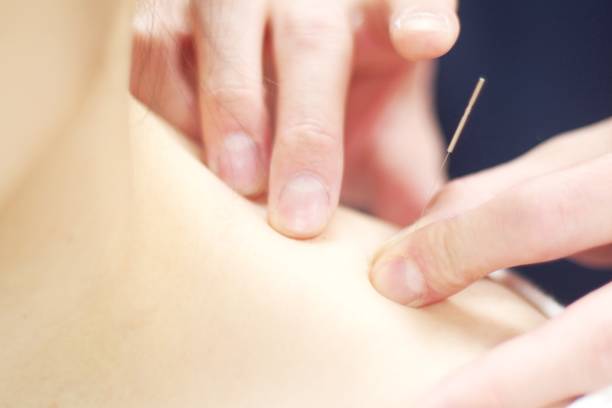 istock Woman receiving acupuncture 670776330