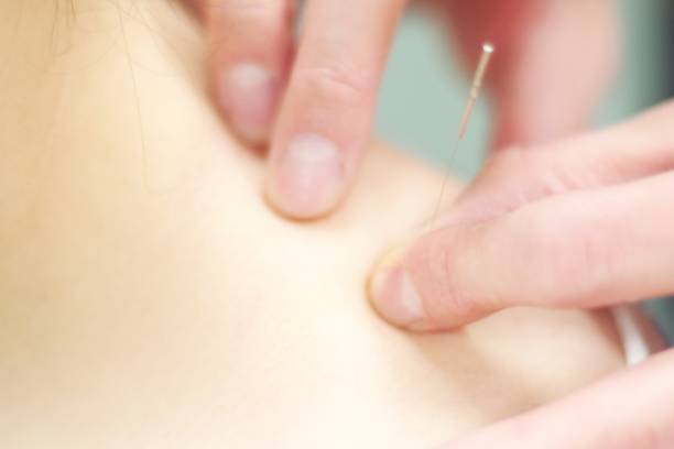 istock Woman receiving acupuncture 670776356