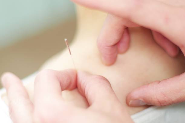 istock Woman receiving acupuncture 670776358