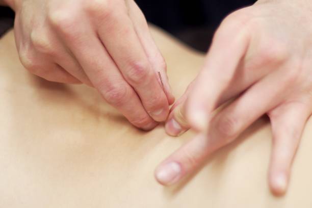 istock Woman receiving acupuncture 670792800